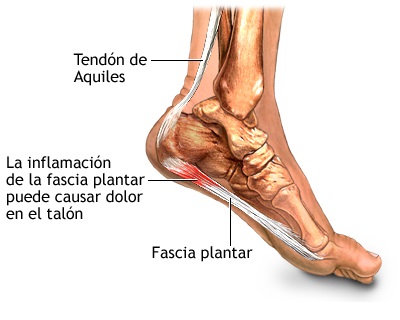 Tratamiento para la fascitis plantar o espolón calcaneo - CIRUGIA PIE Y  TOBILLO-DR BALLESTER